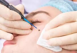 Mole Removal
